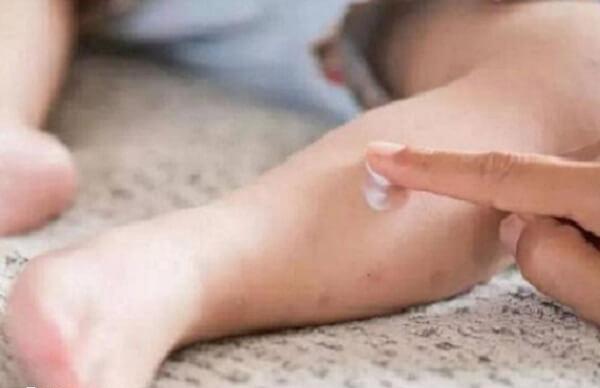 宝宝被蚊虫叮咬后可以给宝宝涂上婴幼儿专用的药膏