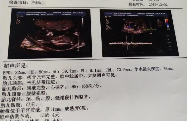 nt是为了筛查胎儿是否有染色体异常的现象
