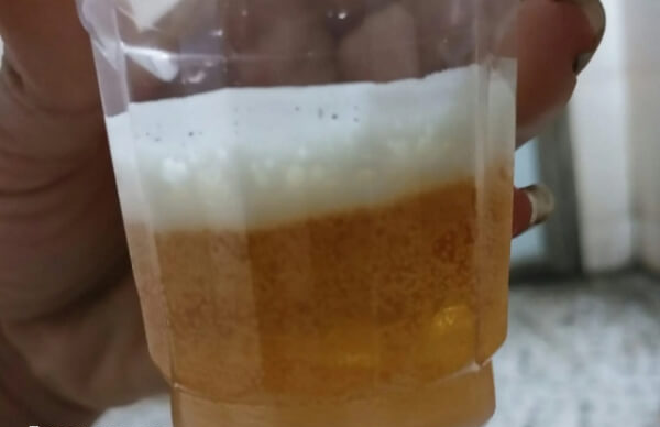 出现白色并产生大量泡沫的话可能怀男孩
