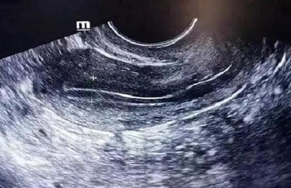 子宫内膜薄可以多吃富含雌激素类的食物