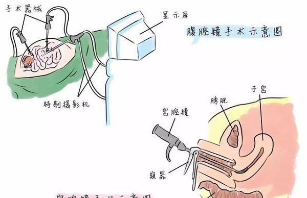 宫腔镜手术过程示意图
