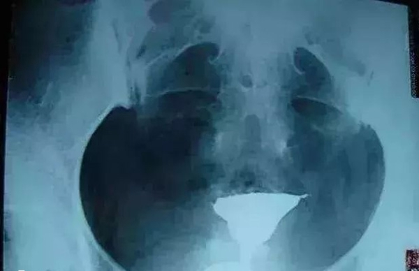 输卵管粘连不可以通过人工授精受孕