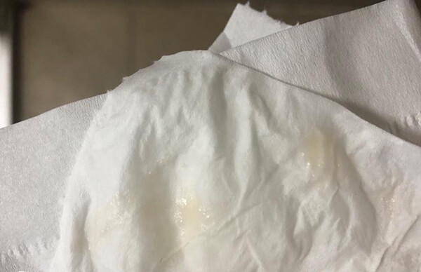 人工周期移植后分泌物减少只是暂时的