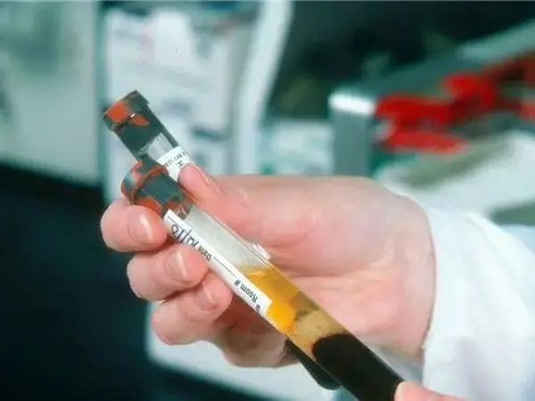 做性激素六项检查要抽取腹腔血液