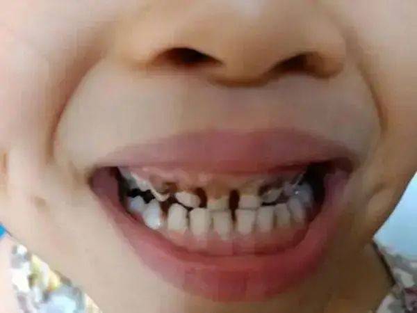 三岁宝宝牙疼要及时去医院检查