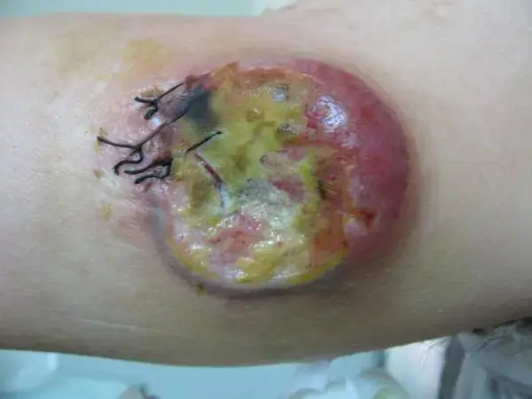 淋巴瘤由于早期无痛常被人们忽视