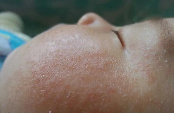 患有荨麻疹的人群一定要注重日常中的预防