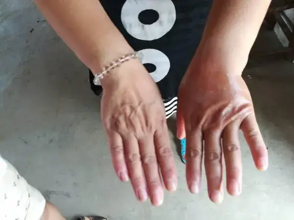 引起手指发胀的原因有很多