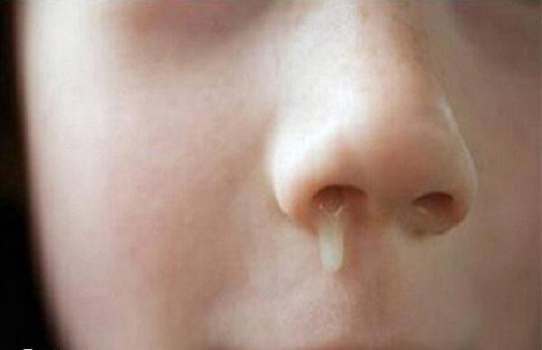 儿童鼻炎要及时去医院治疗