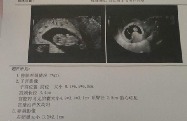怀孕45天的时候属于孕早期