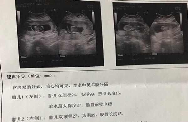 出现羊膜囊要及时去医院检查