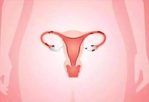 子宫内膜薄妊娠过程中容易出现各种并发症
