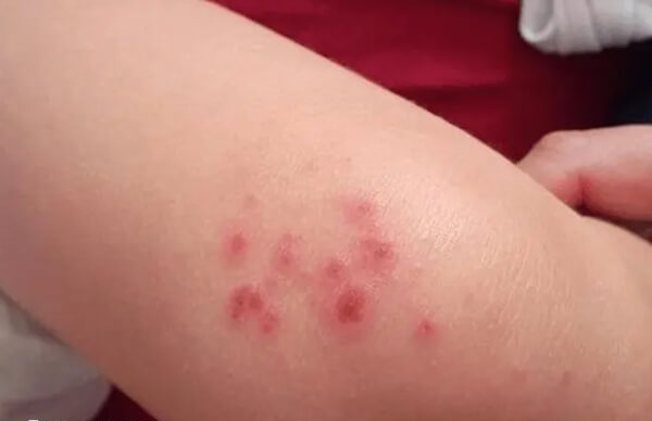 胎毒属于产后急性过敏的一种表现