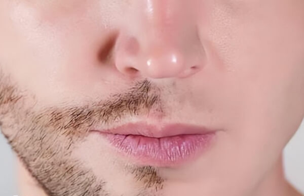 男性长期吃补佳乐会导致体毛脱落