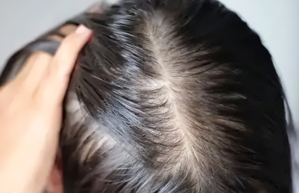 孕期头发油是激素水平变化所致