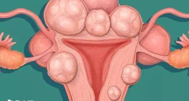 子宫腺肌瘤过大可能会影响成功率