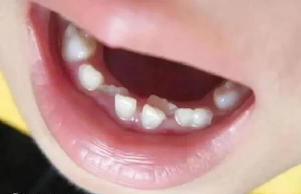 长期使用奶嘴会导致牙齿排列不整齐