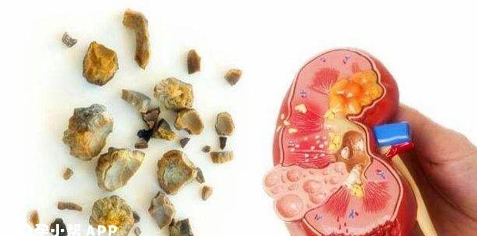 肾结石病人不能吃太油腻的食物