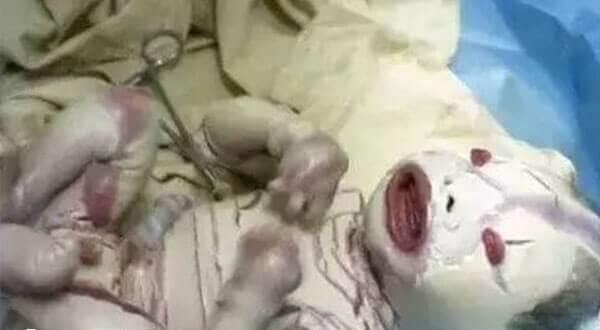 火棉胶婴儿有存活几率