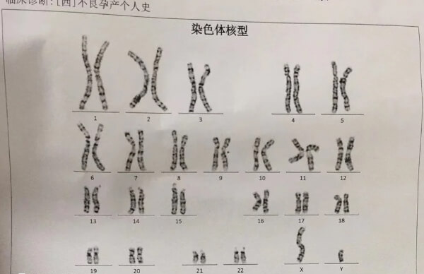 1号染色体异常做三代试管婴儿可以避免后代遗传