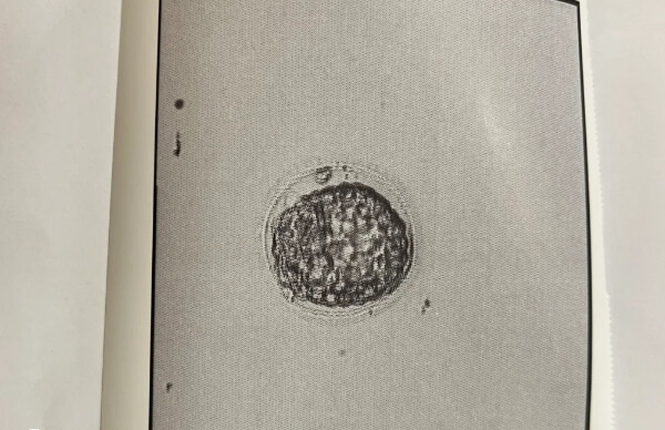 囊胚移植前需要经历内膜转化阶段