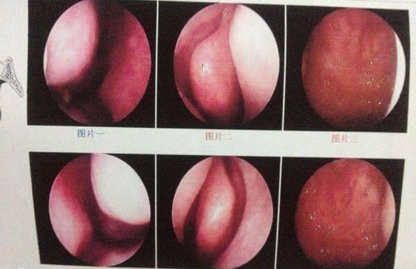 宝宝鼻炎可能会出现反复发作