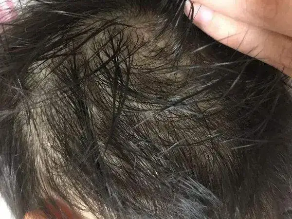 小孩容易出汗要及时查明原因