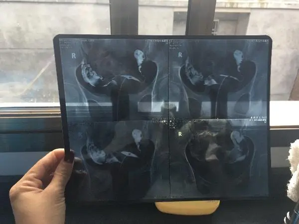 输卵管检查可能会有一些不适感