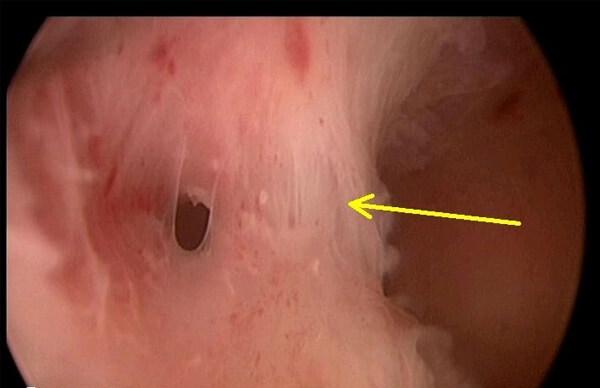 宫腔镜下做宫腔粘连分离手术