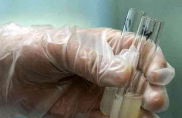 白细胞精子症精液会变黄