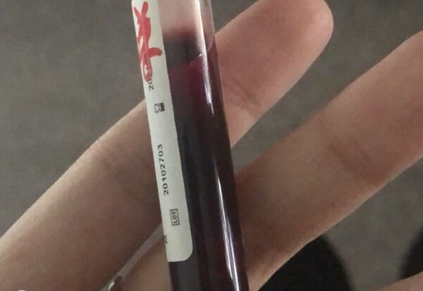 做试管期间要控制好血糖