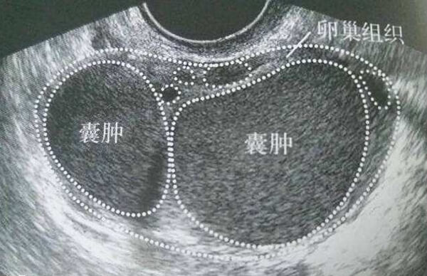 巧克力囊肿不降调会导致试管婴儿失败