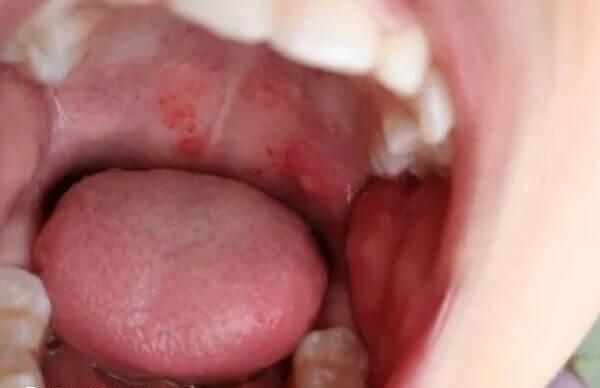 口腔溃疡比较严重要及时治疗