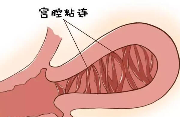 根据宫腔粘连的症状表现可自测