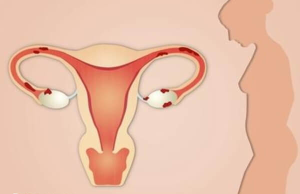 女性要重视子宫内膜和输卵管相关检查