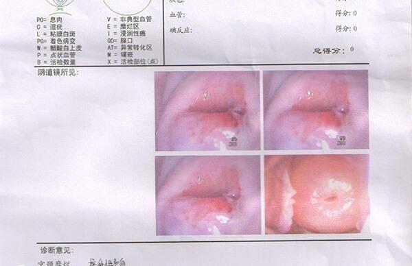 宫颈肥大是慢性宫颈炎