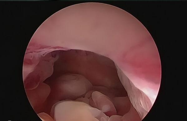 子宫内膜息肉可考虑宫腔镜手术