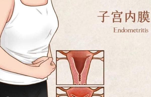 子宫内膜感染也会导致宫腔粘连