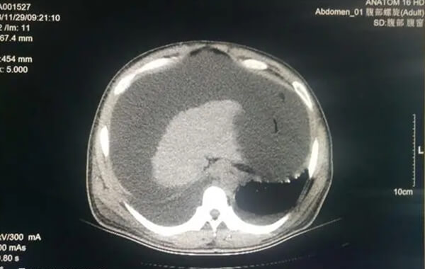 取卵后腹水的治疗要看腹水轻重程度