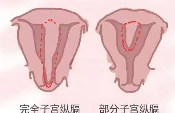 严重纵隔子宫不做手术容易反复流产