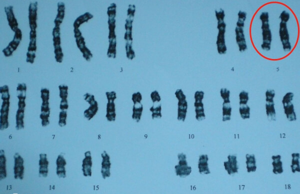 5号染色体缺失会负面影响孩子一生
