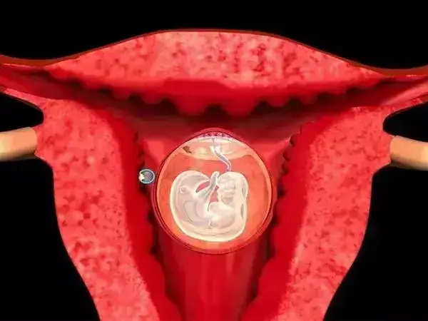 宫腔粘连会导致女性难以生育