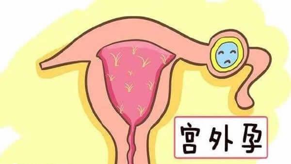宫外孕