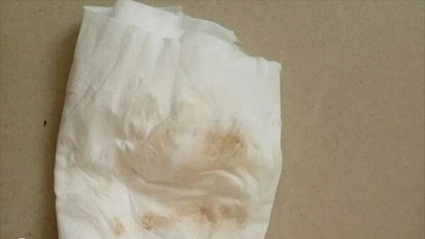 肚子发硬是女性宫缩的症状之一