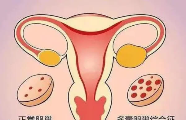 发现多囊后但不治疗最终会导致不孕症