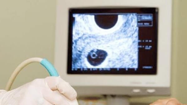 腺肌症患者做三代试管成功率在30%