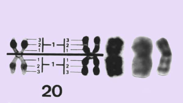 20号染色体片段缺失对胎儿影响很大