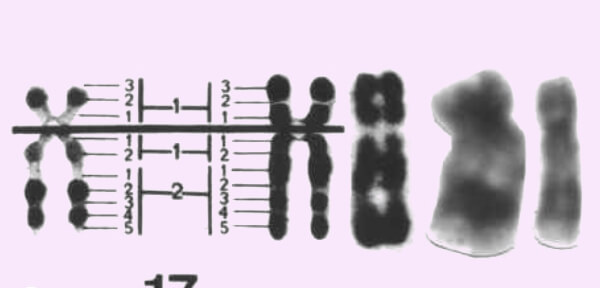 胎儿17号染色体异常大多都和父母有关