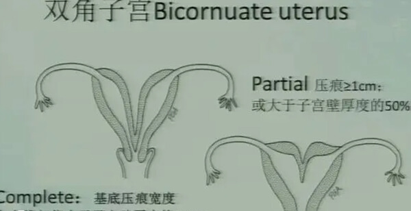 双角子宫通过B超检查就能诊断