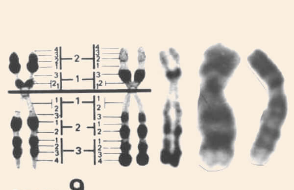 9号染色体三体是染色体异常的表现